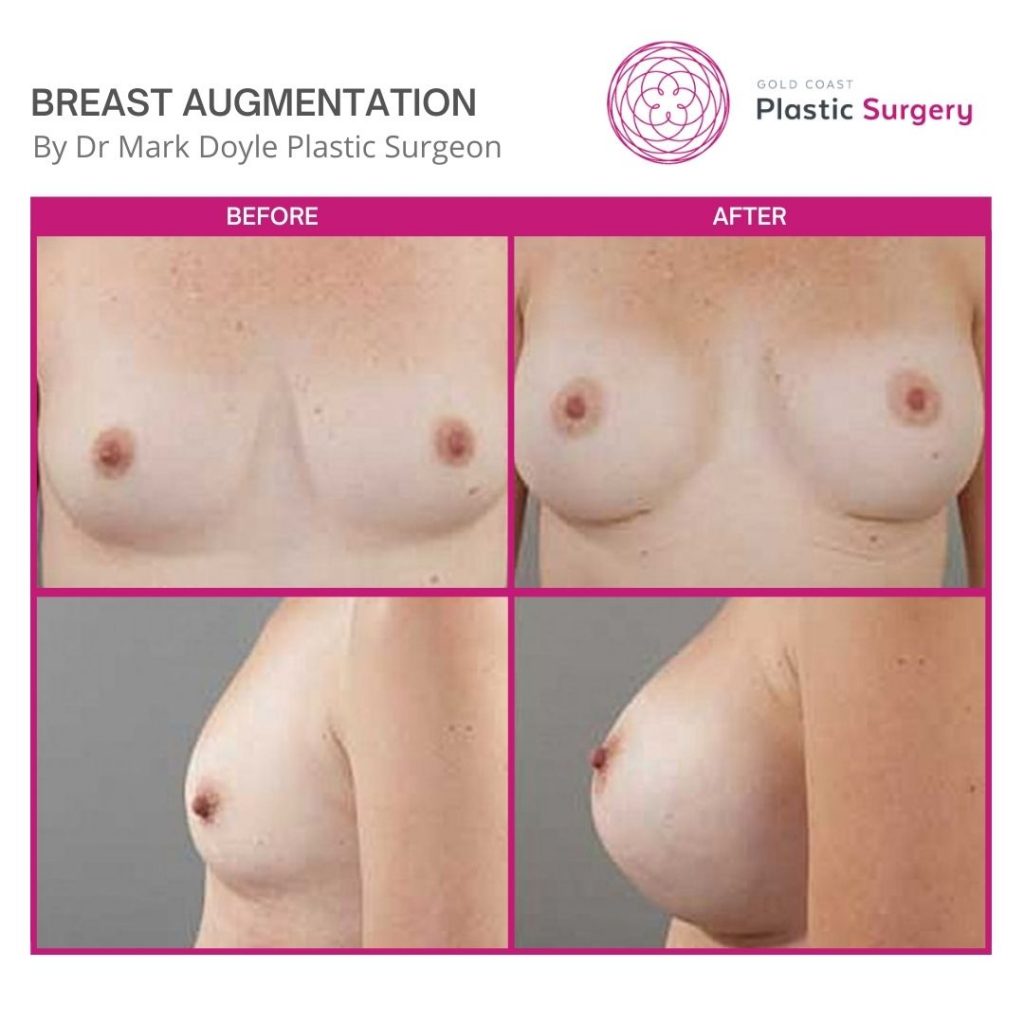 breast augmentation plastic surgery before and after images