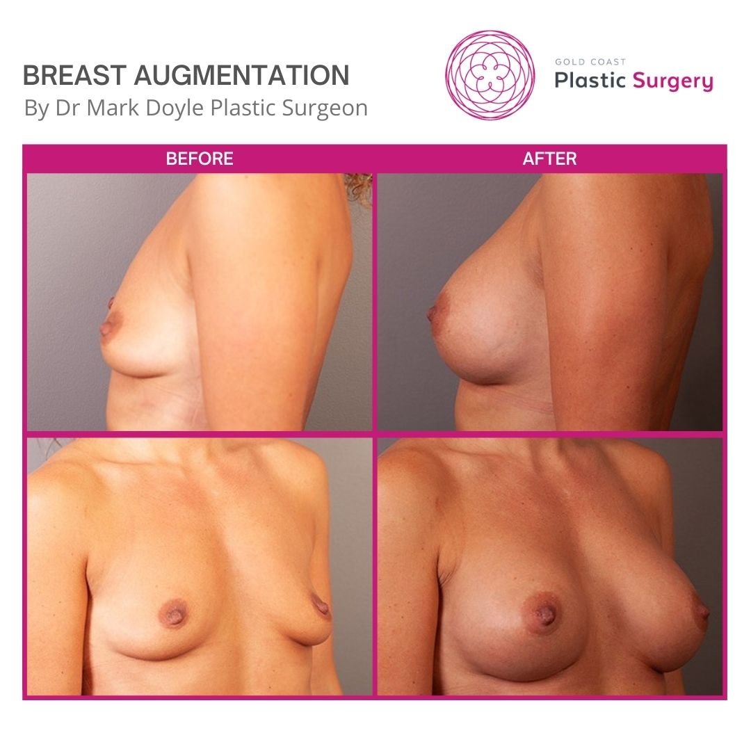 boob job images before and after