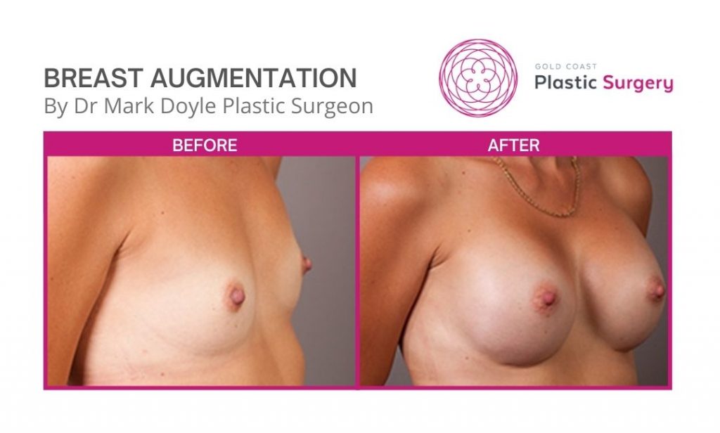 breast augmentation before and after images 1