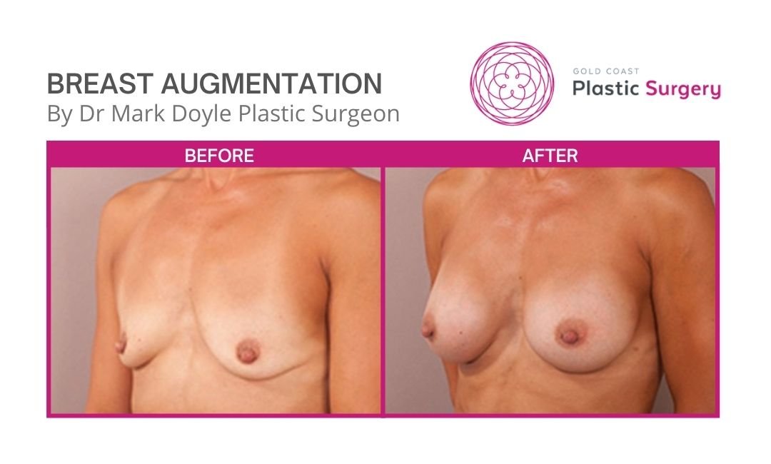 breast augmentation before and after images nsw