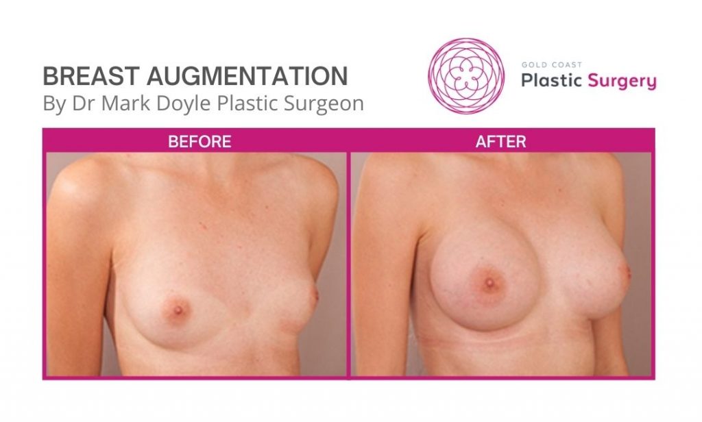 breast augmentation images brisbane