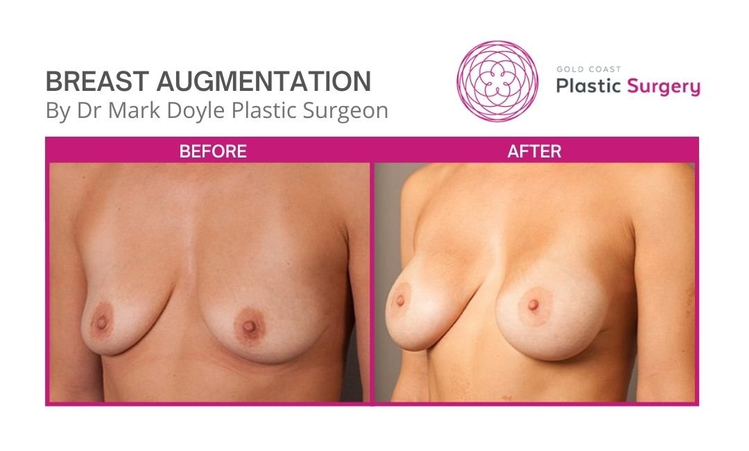 breast augmentation images plastic surgery