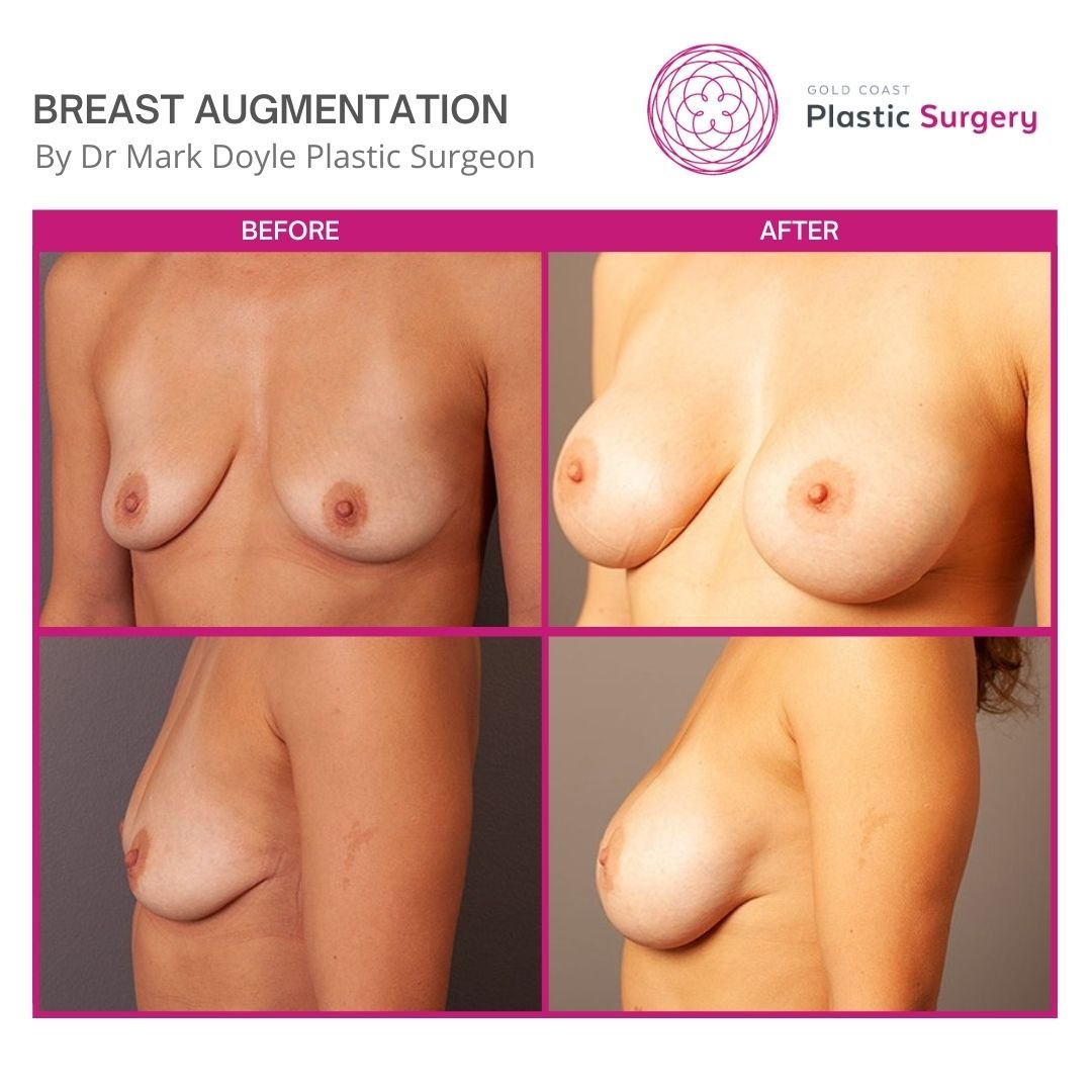 breast augmentation surgery images