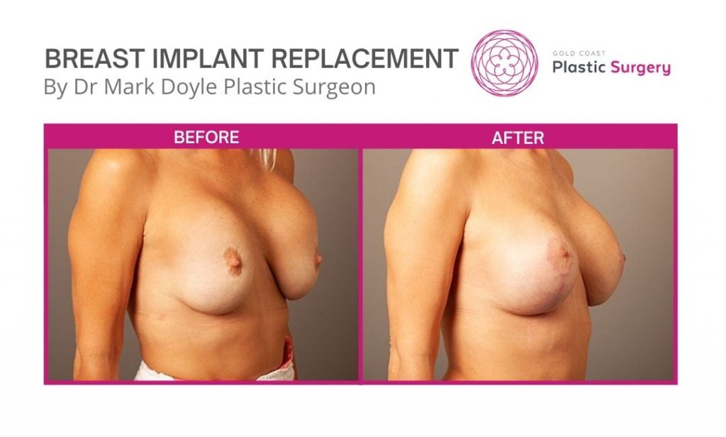breast implant replacement before and after images