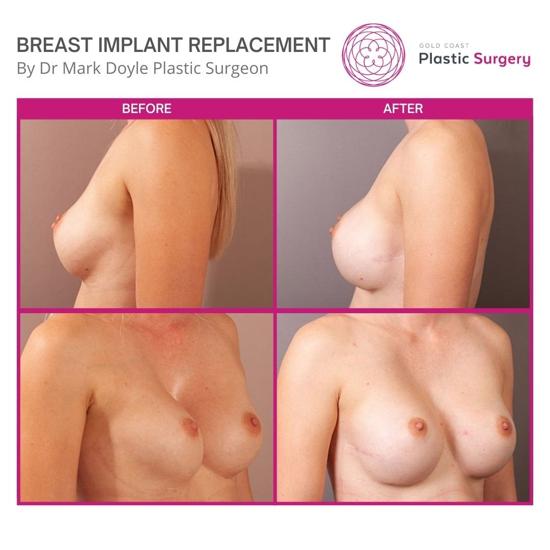 breast implant replacement before and after pictures