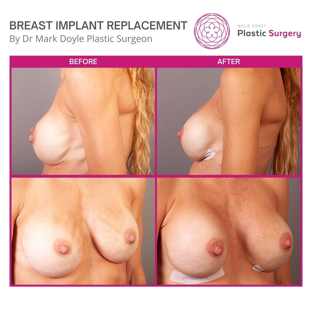 breast implant replacement brisbane images