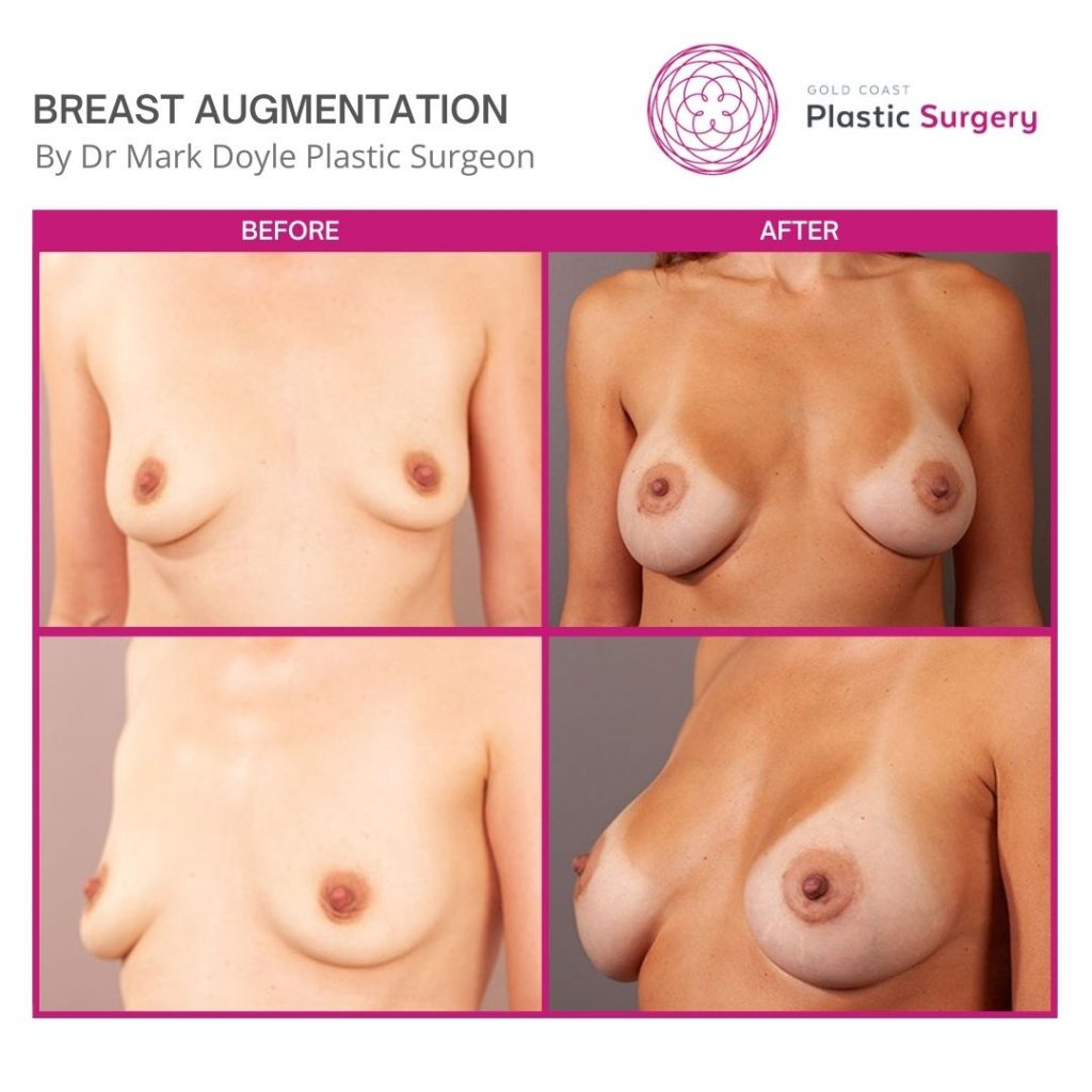 breast implants before and after images
