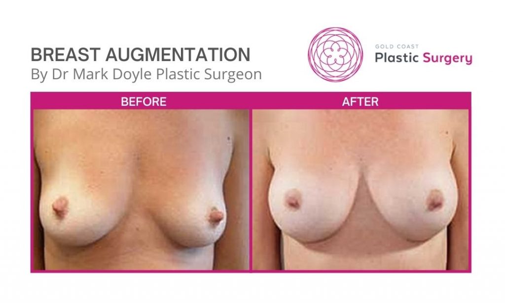 breast implants before and after images nsw