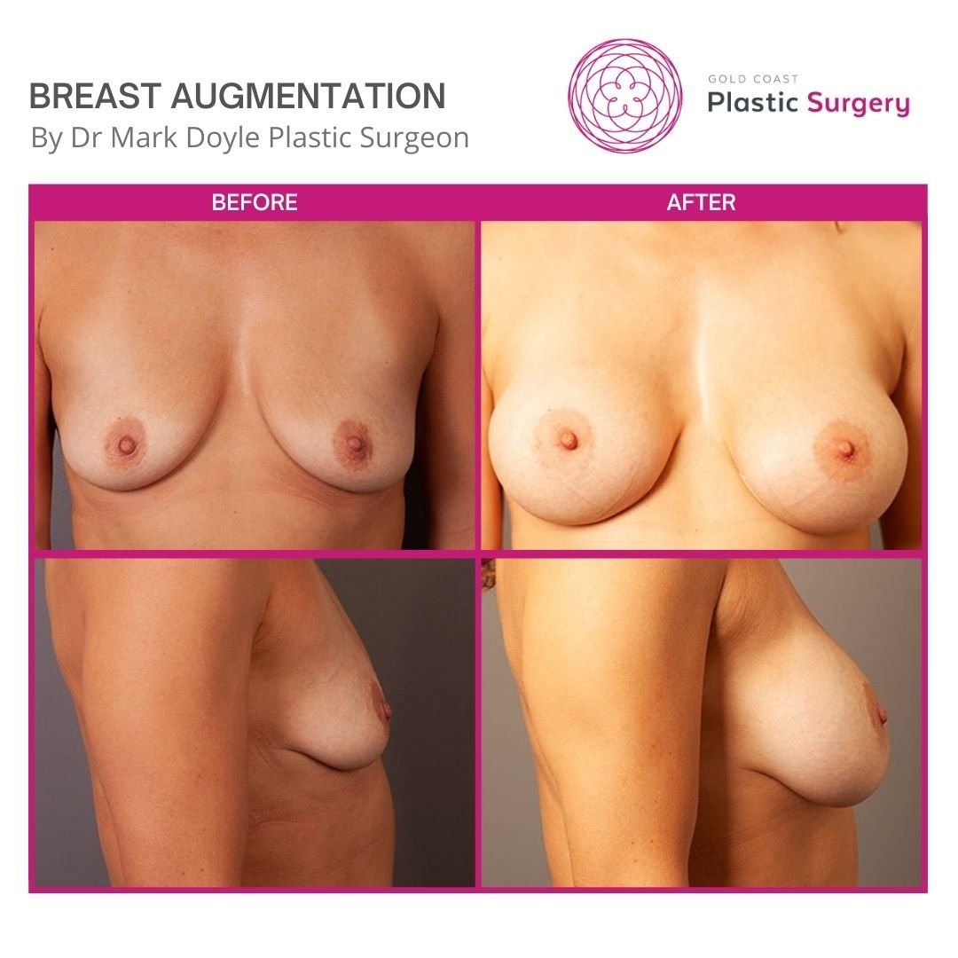 breast implants before and after images sunshine coast