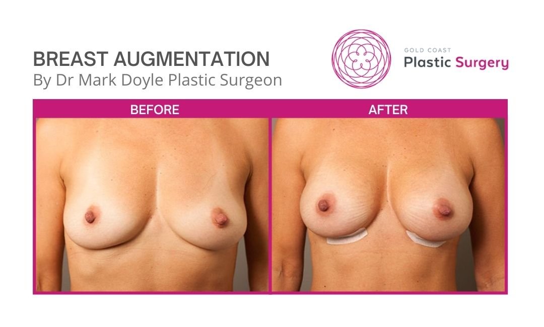 breast implants natural result