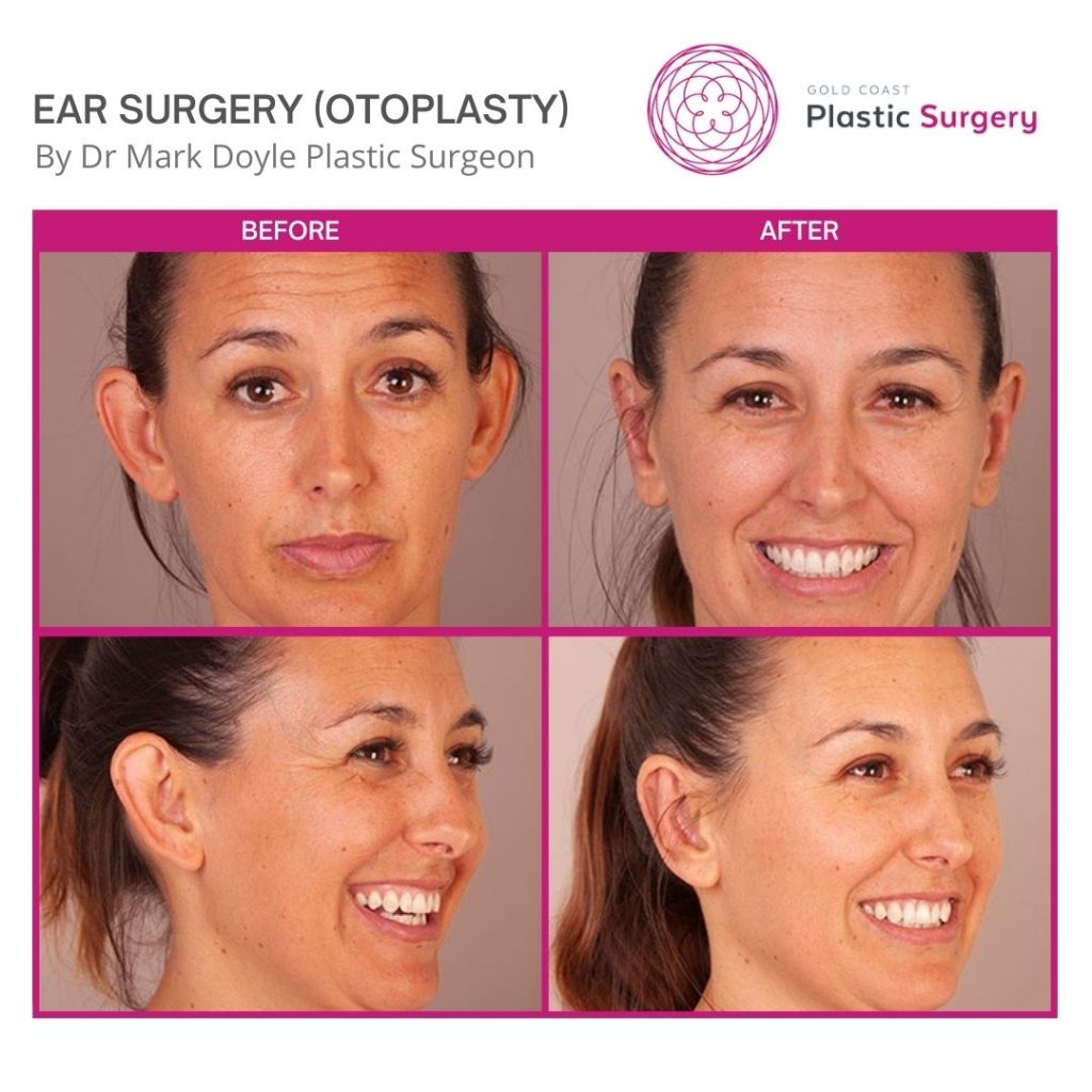 ear surgery before and after images Gold Coast Plastic Surgery