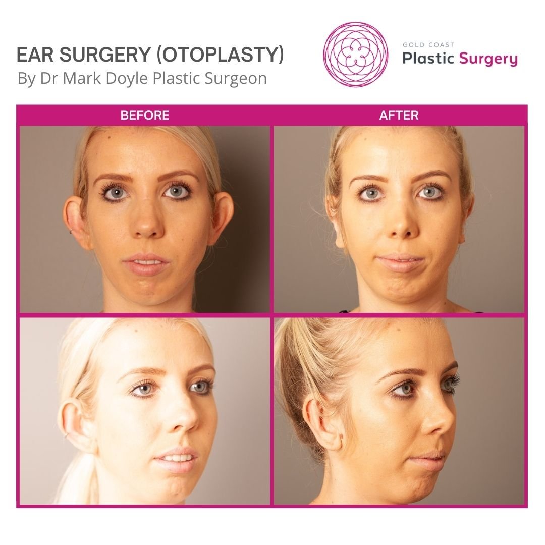 ear surgery before and after pictures sunshine coast