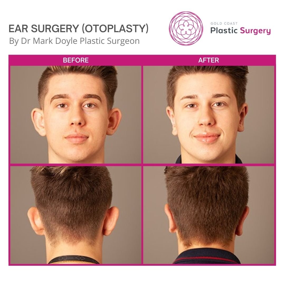 ear surgery plastic surgery before and after images
