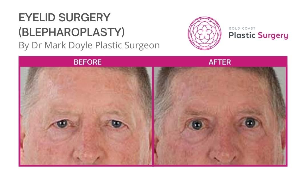 eyelid surgery before and after brisbane