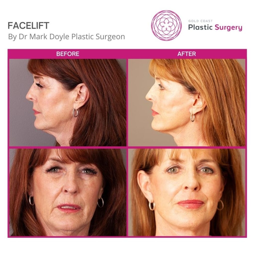 40 year-old facelift before and after
