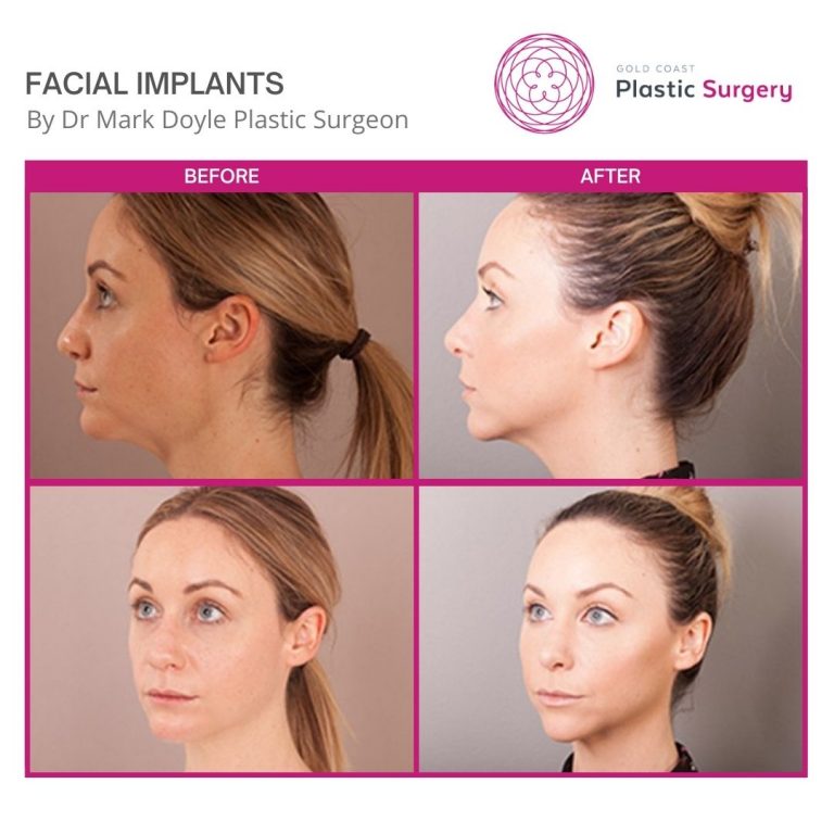 facial implants before and after images brisbane Gold Coast Plastic