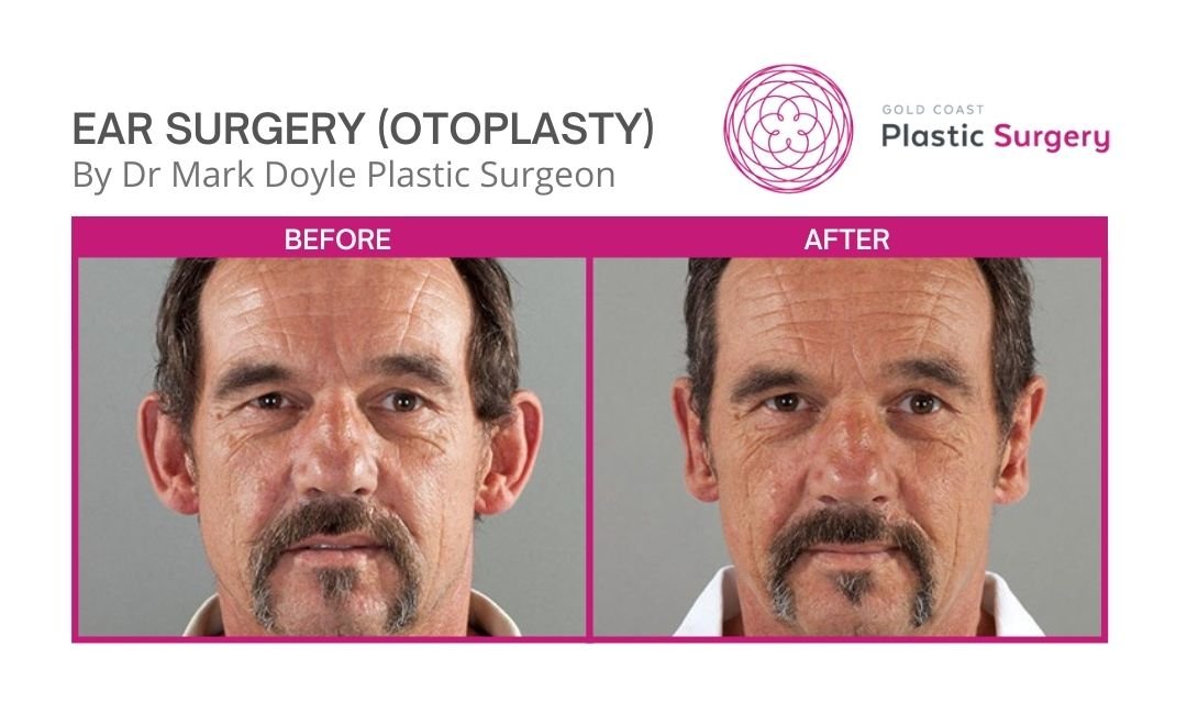 otoplasty before and after images