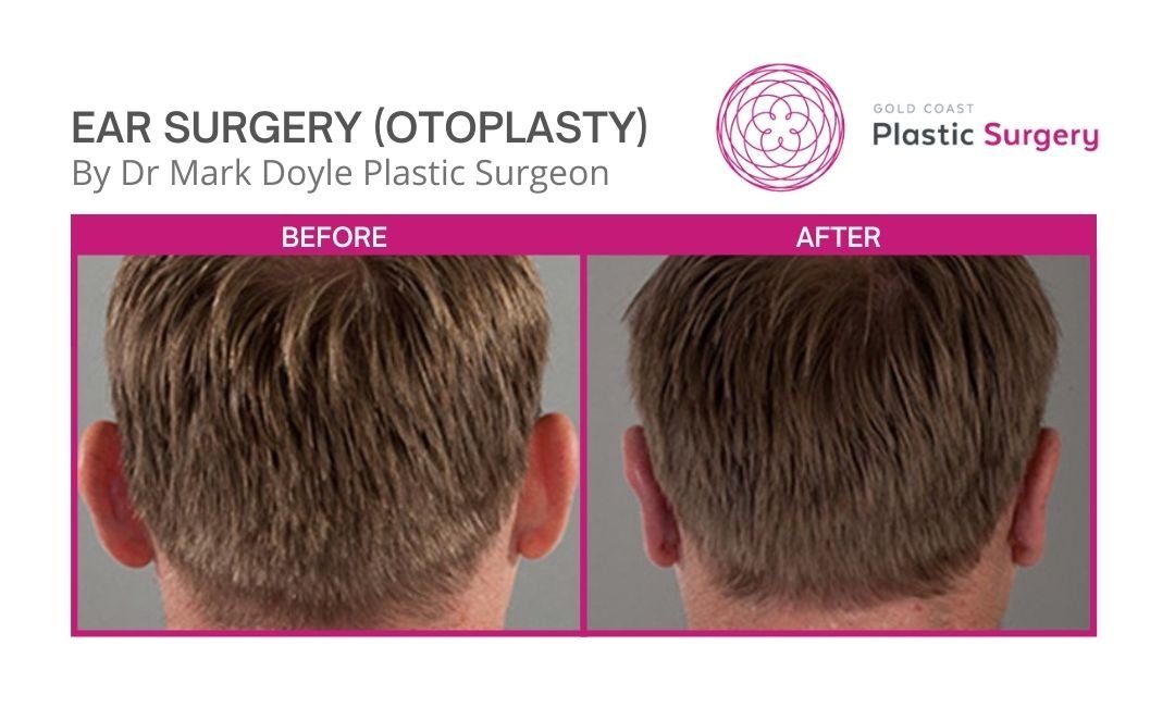 otoplasty images before and after