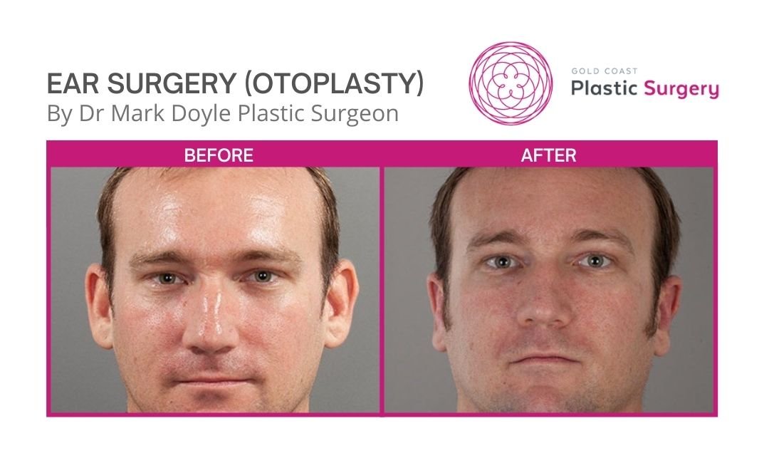 otoplasty plastic surgery before and after images