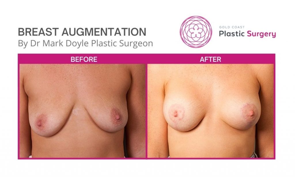 plastic surgery before after images