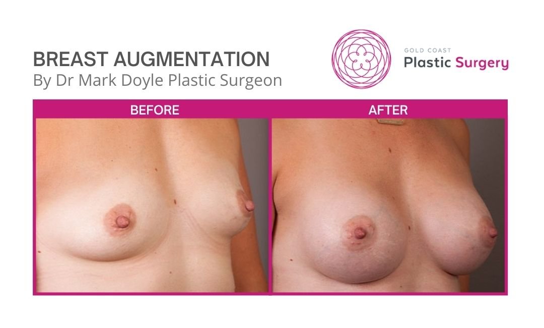real breast implant before after images