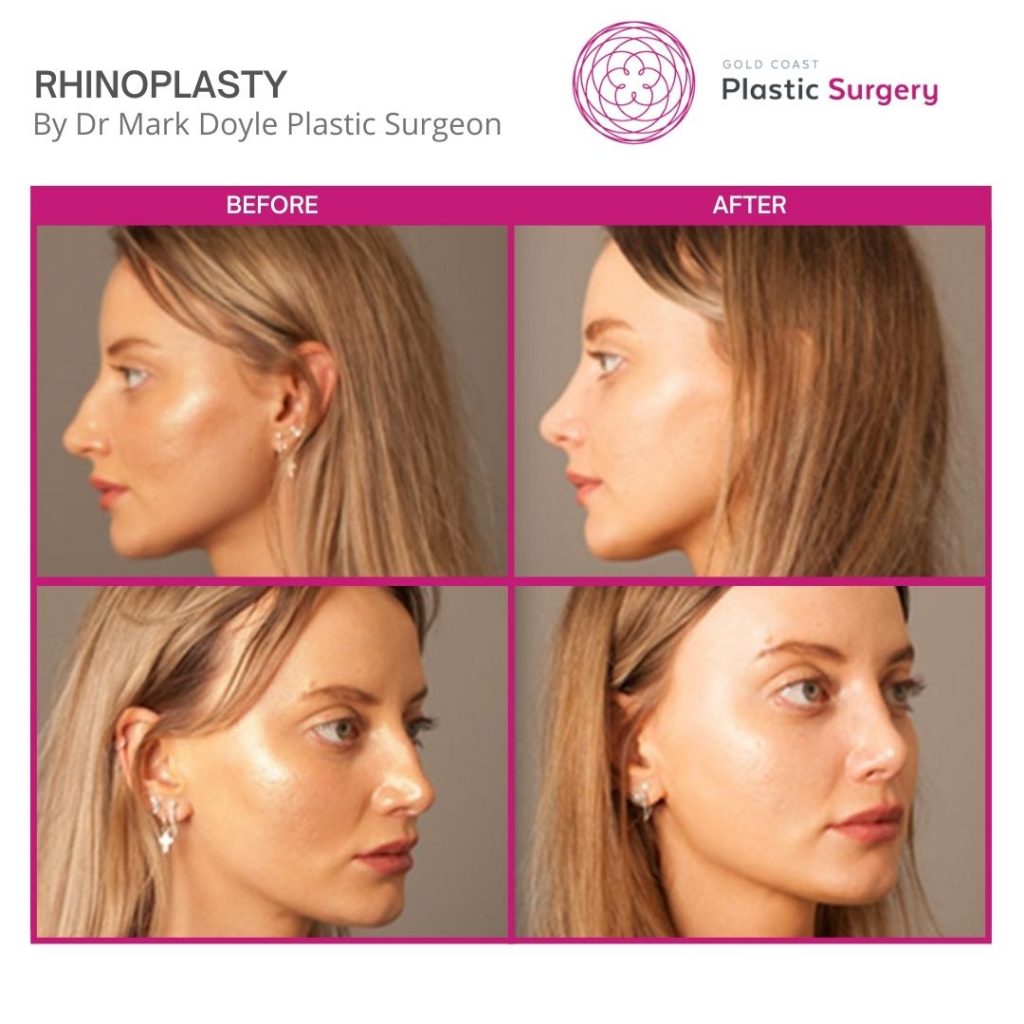 rhinoplasty before and after australia