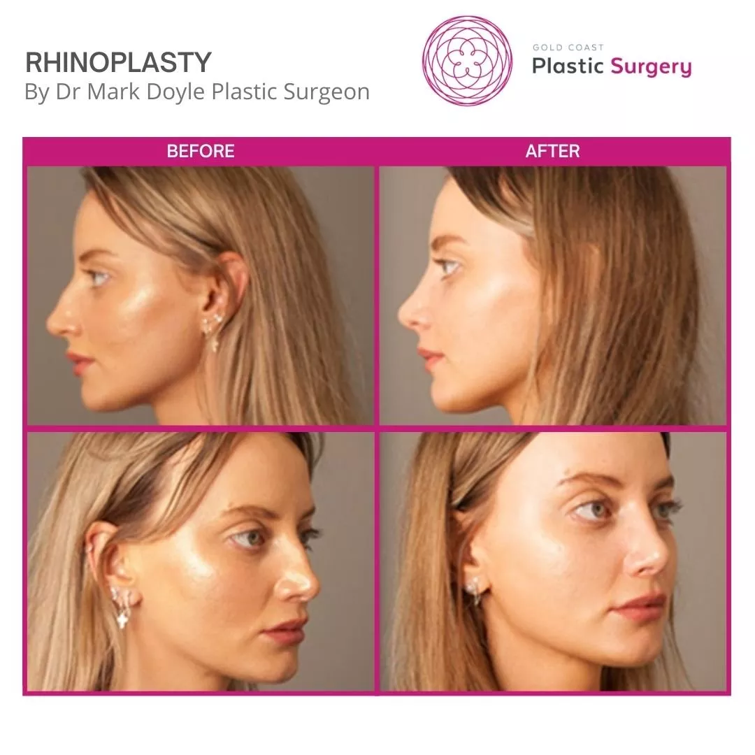 rhinoplasty cost