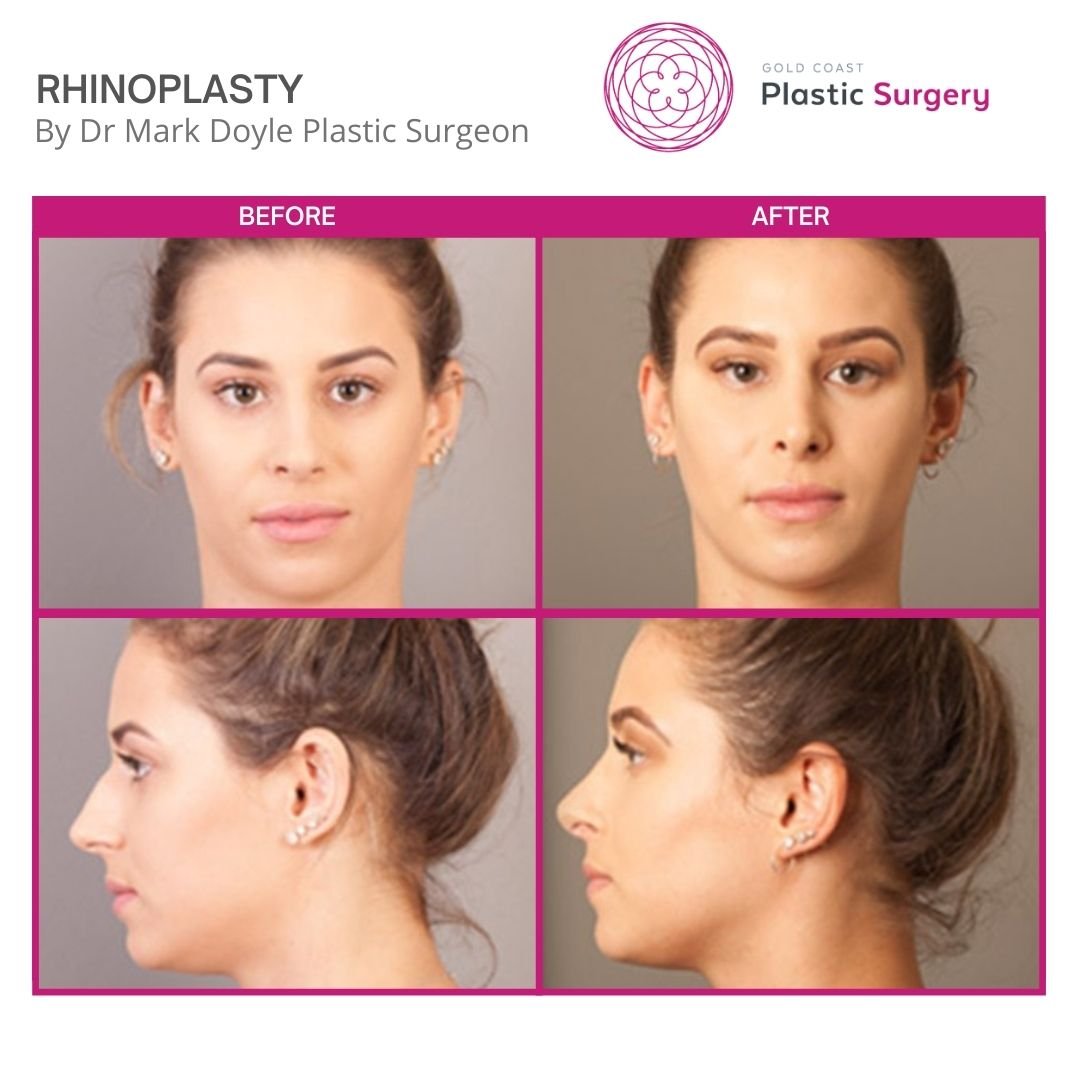 rhinoplasty before and after pictures wide nose