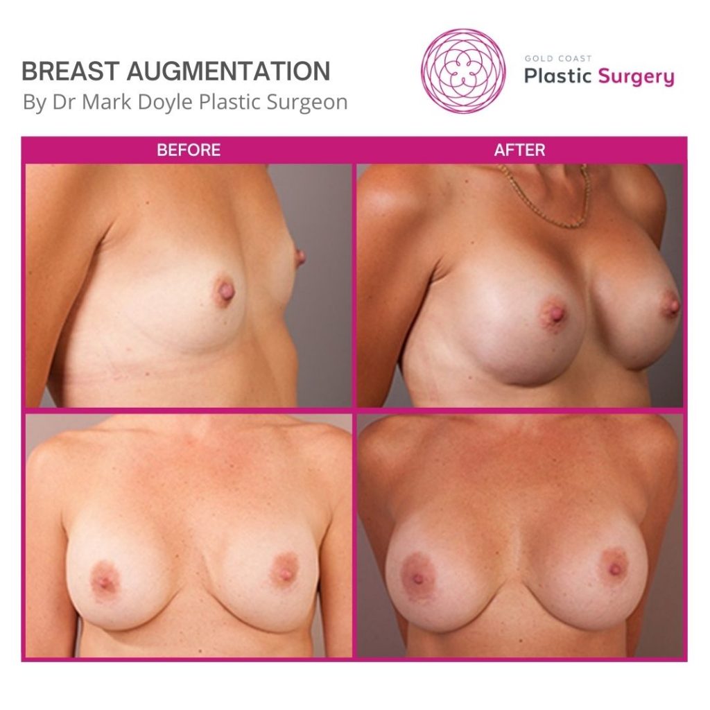 sunshine coast breast implants