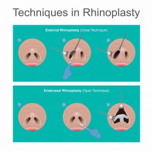techniques in tip rhinoplasty procedure queensland australia