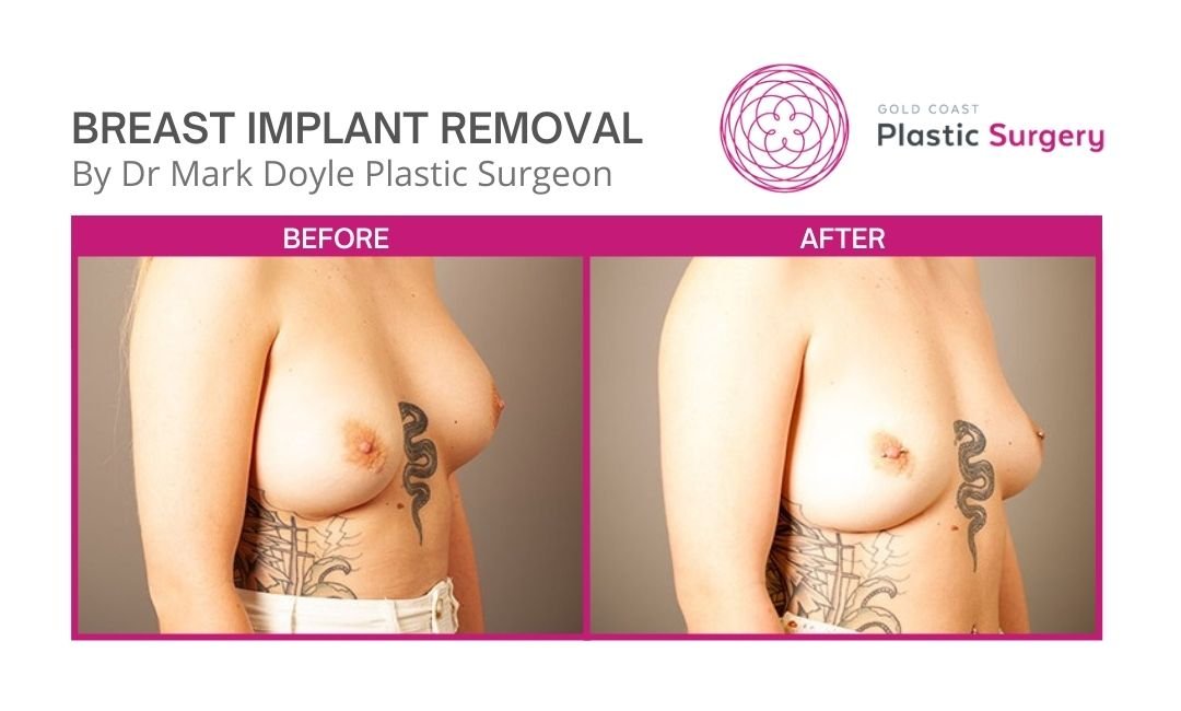 Breast Implant Removal images before after