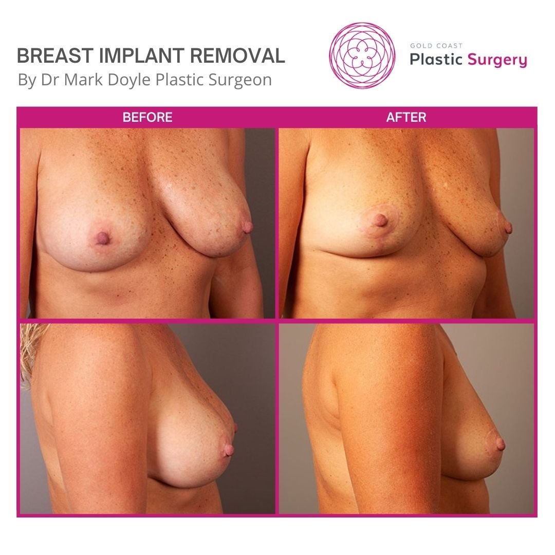 before after breast explant en bloc