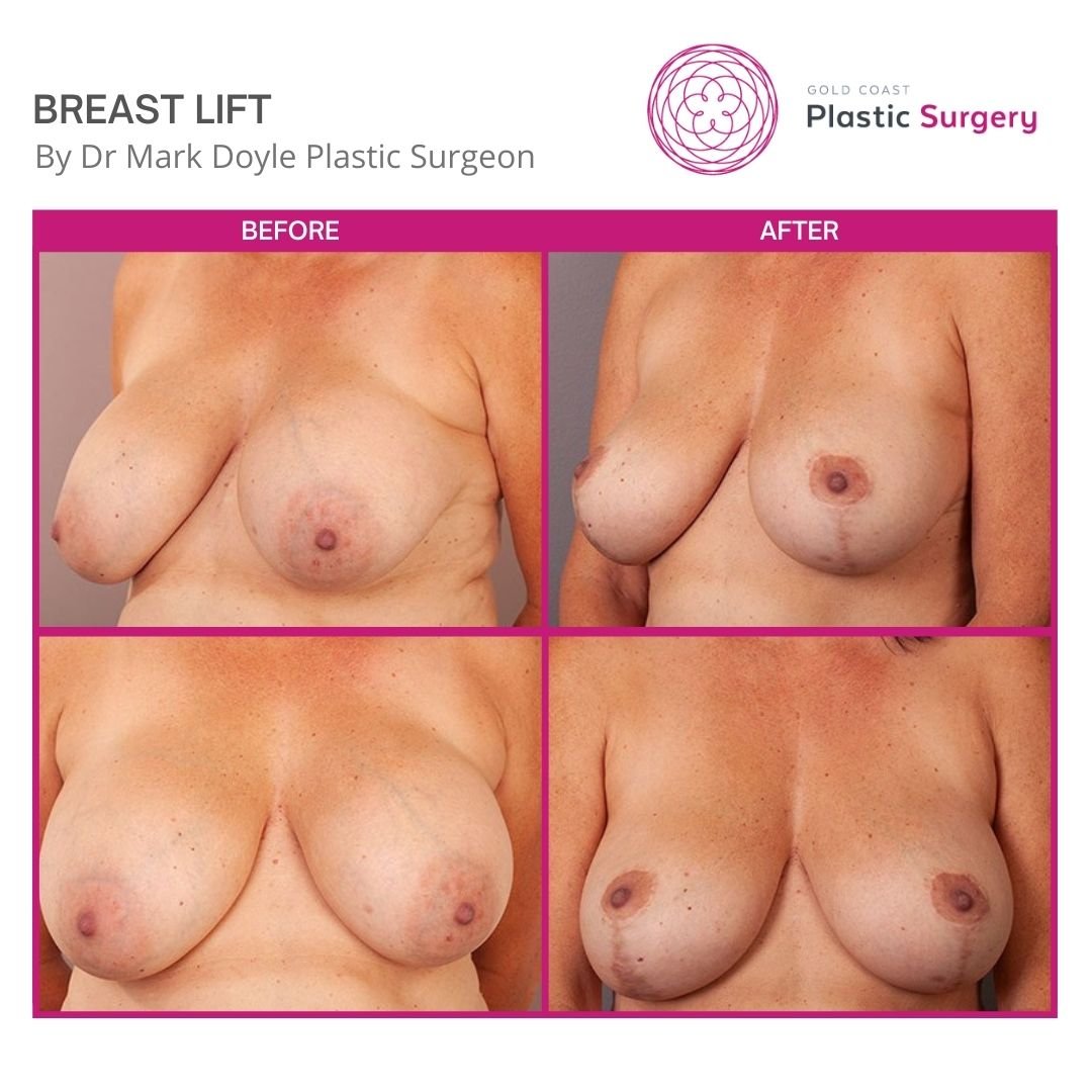 before after breast lift surgery