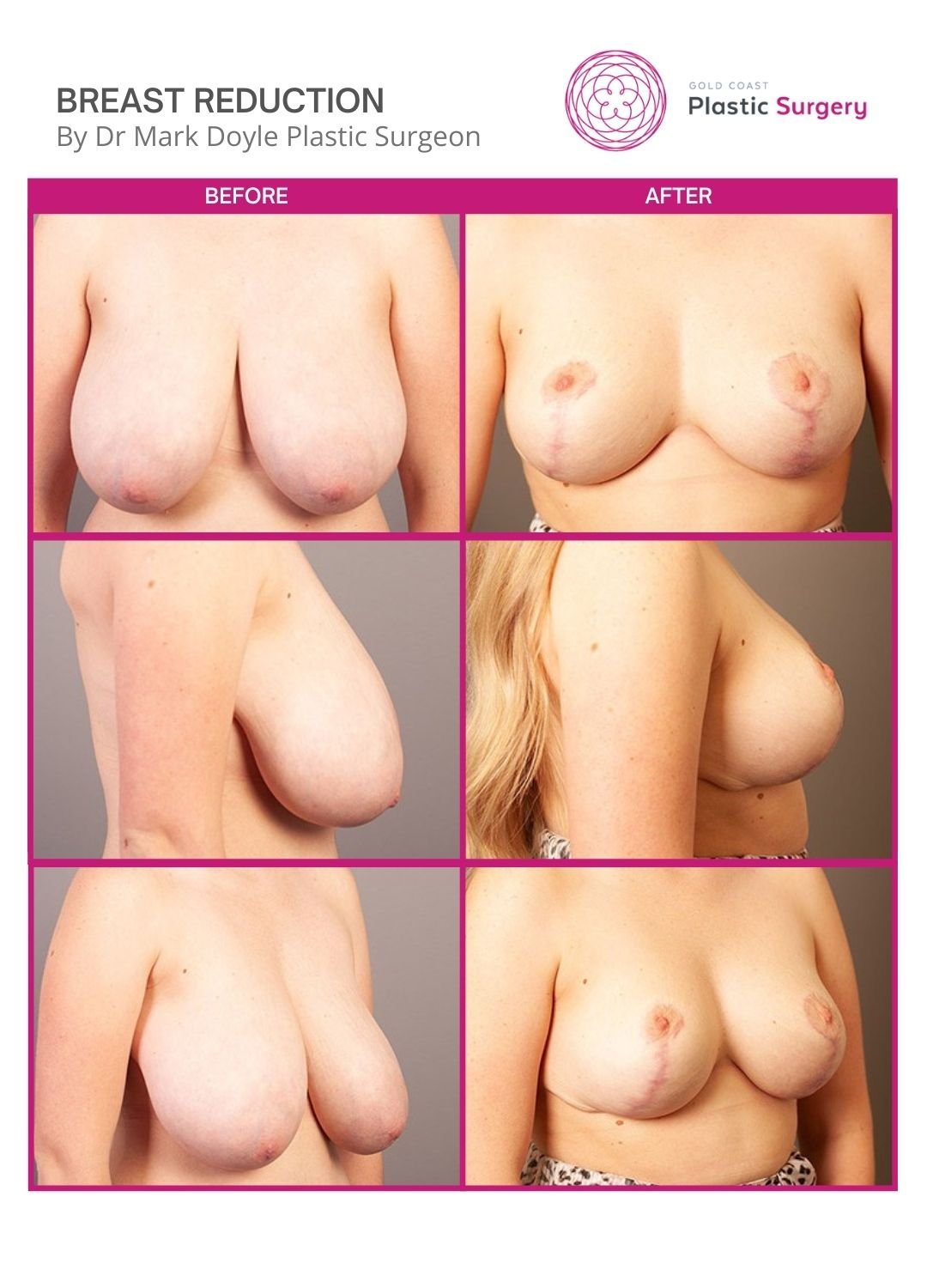 before after breast reduction brisbane