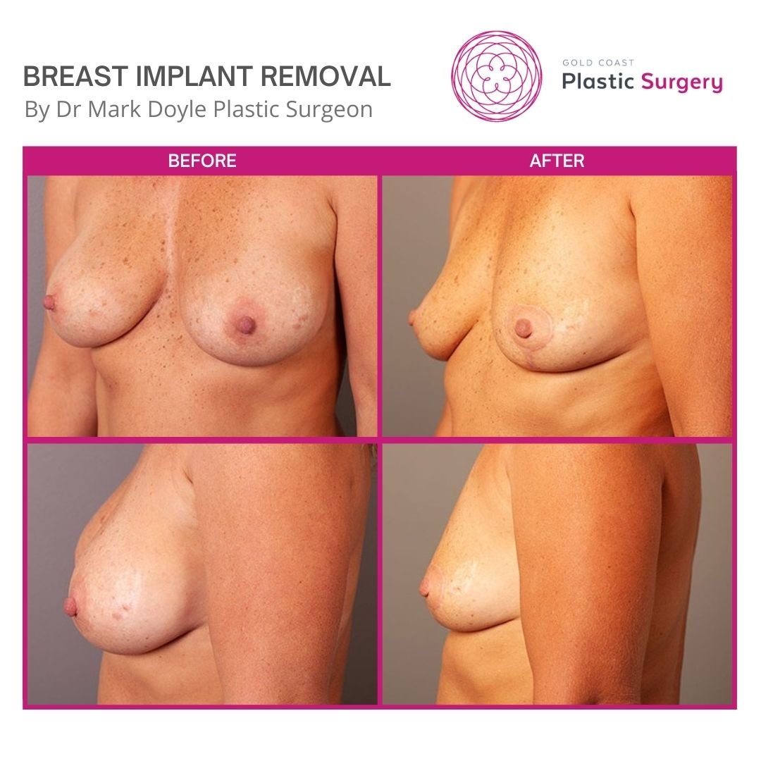 before and after images breast implant removal