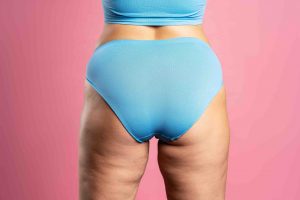 before and after images of thigh lift surgery for loose skin