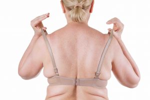 bra line back lift plastic surgery queensland