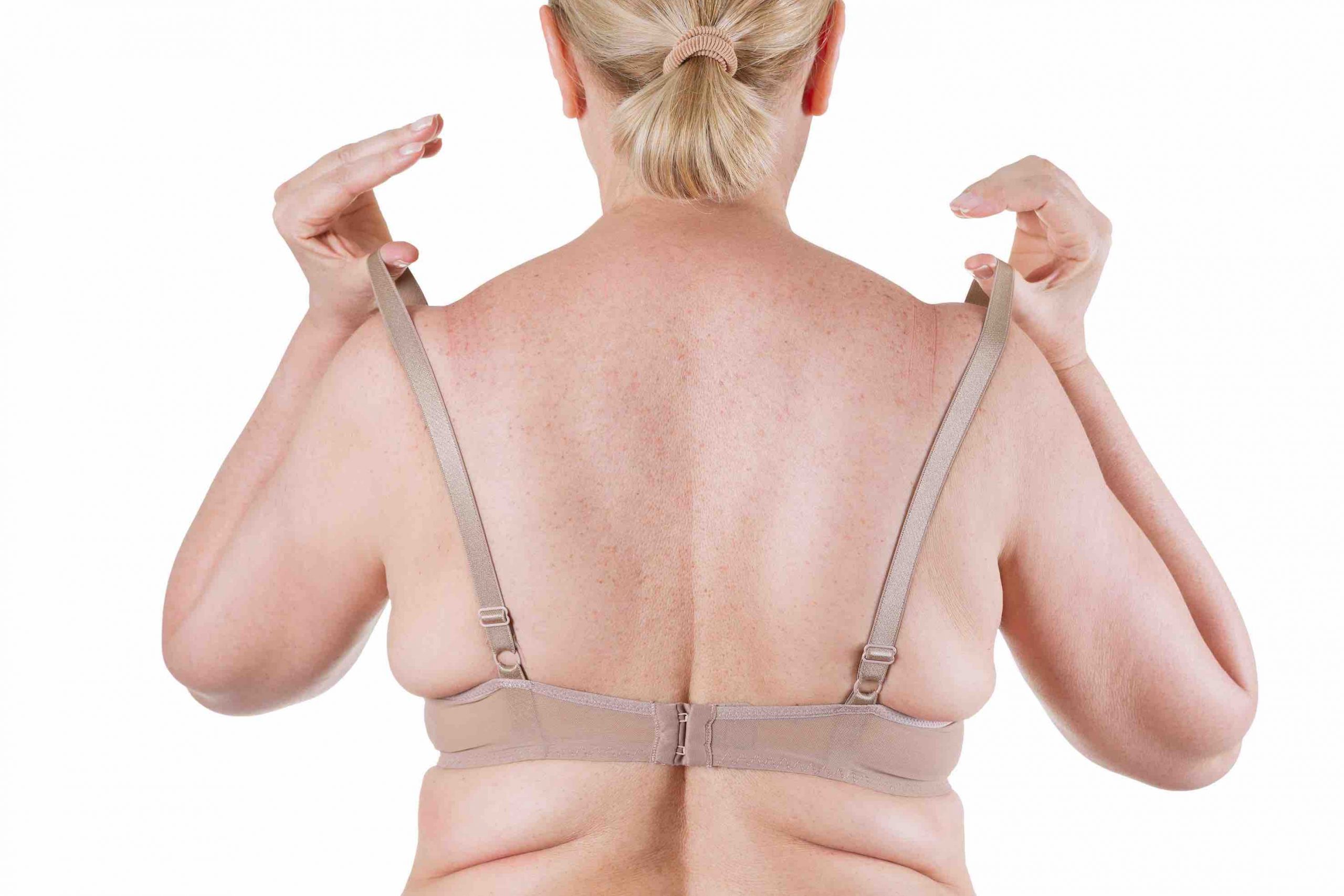 https://goldcoastplasticsurgery.com.au/wp-content/uploads/2021/01/bra-line-back-lift-plastic-surgery-queensland-scaled.jpg