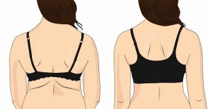 bra-line back lift surgery cost australia for stubborn back fat