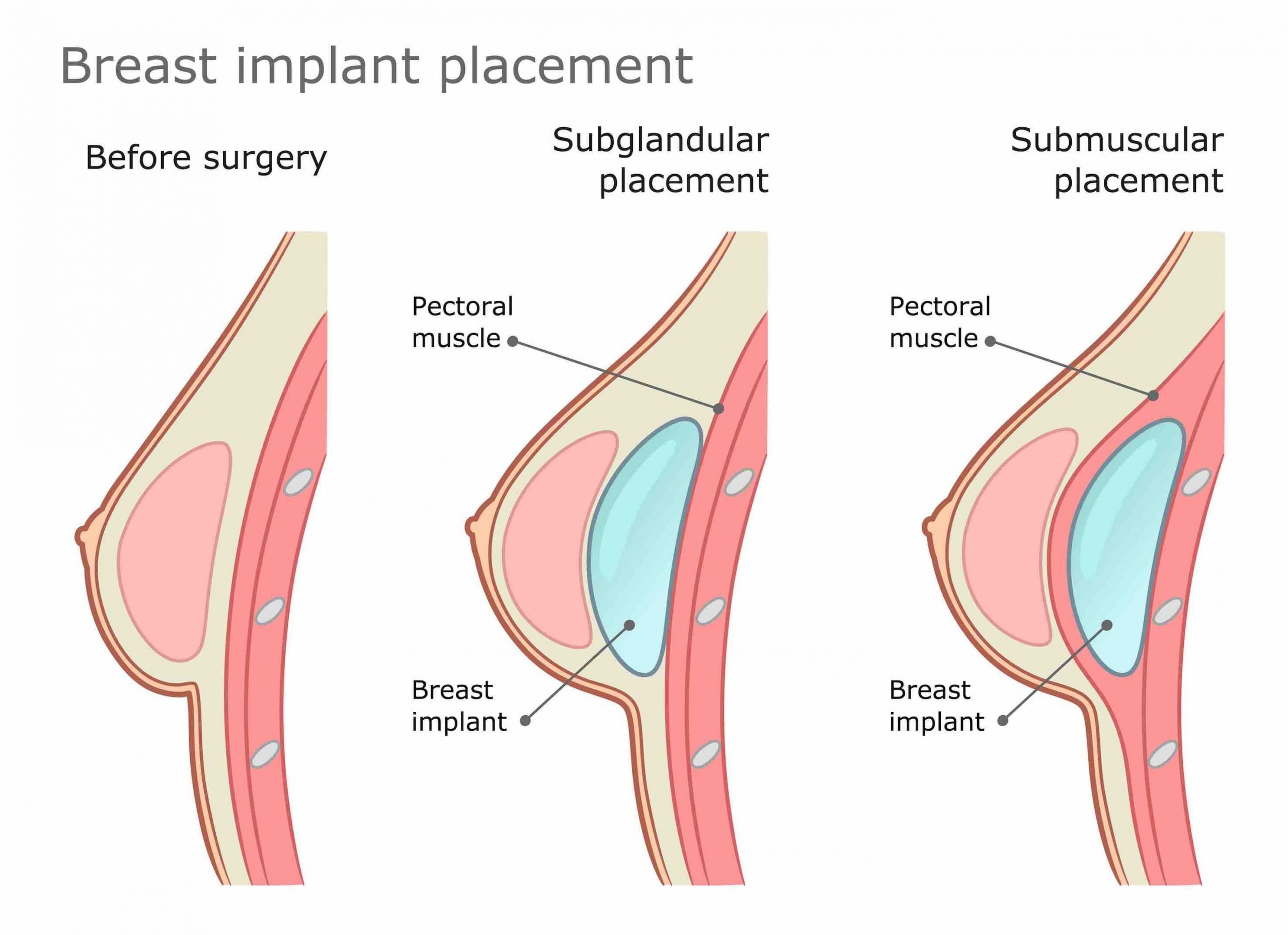 Breast implant placement above below muscle