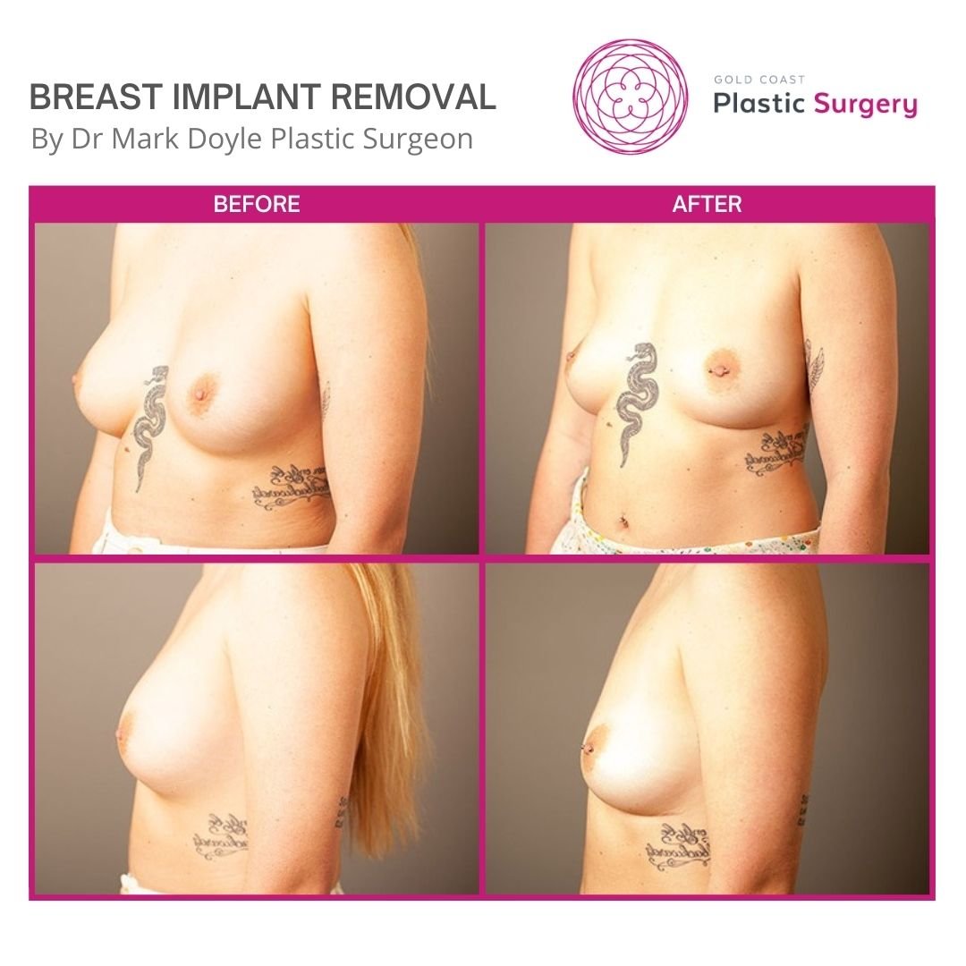 breast implant removal before and after photos