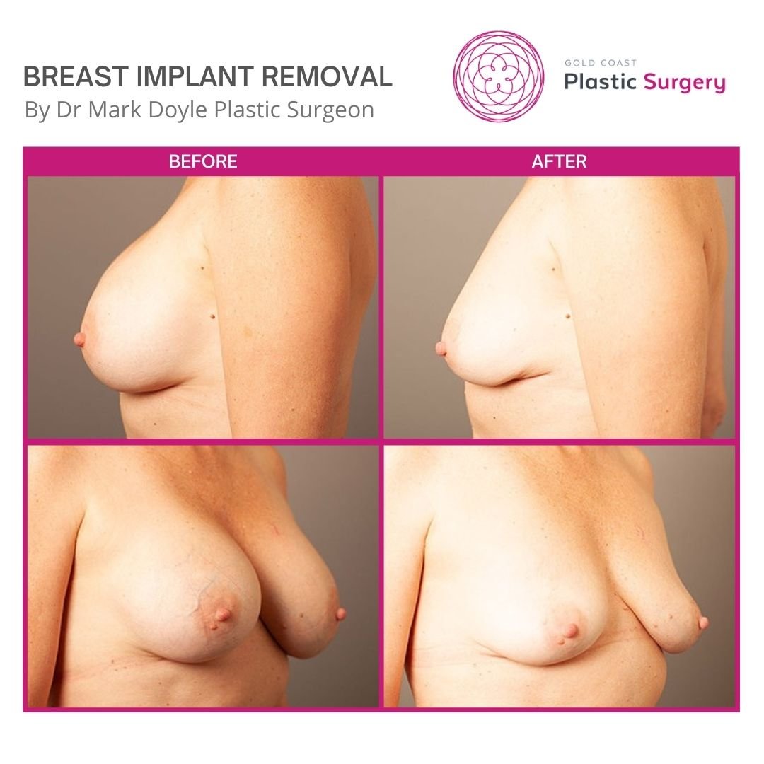 breast implant removal surgery queensland images