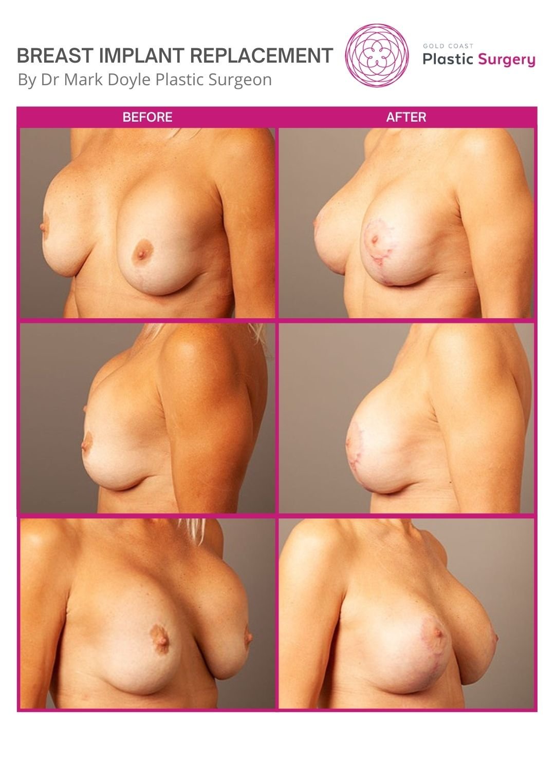 breast implant replacement before and after images