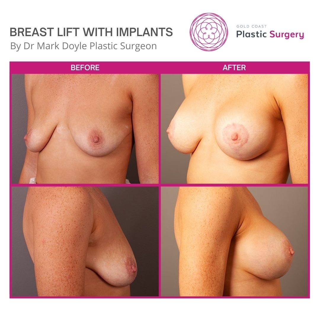 breast lift and implants images