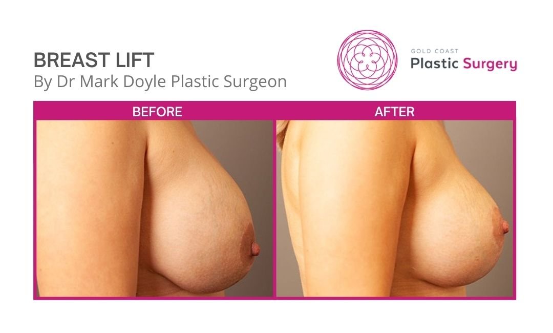 breast lift images