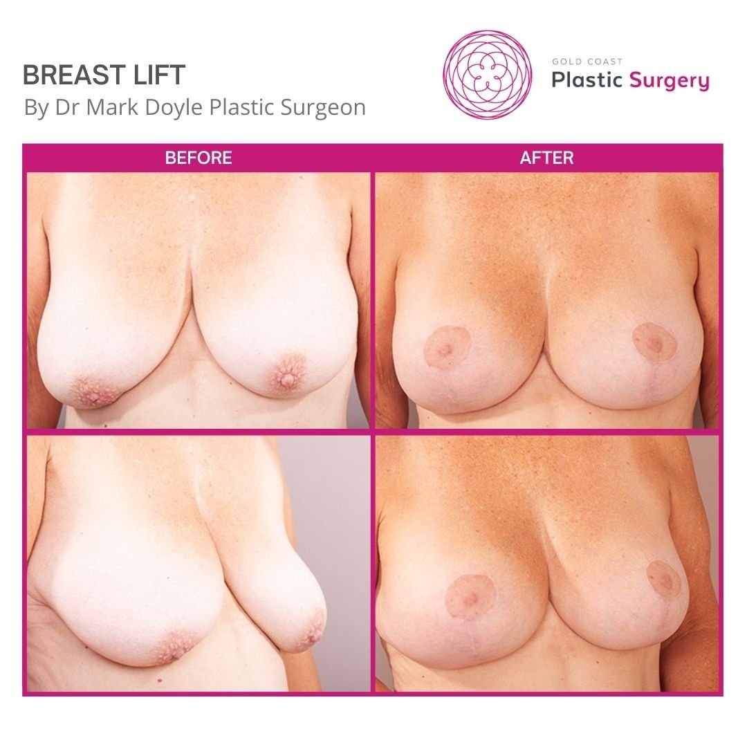 breast lift before after photos