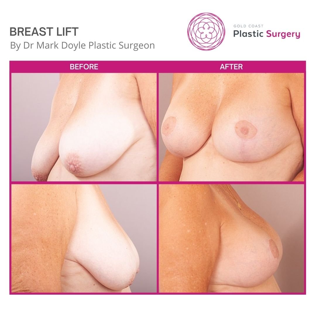 breast lift surgery brisbane