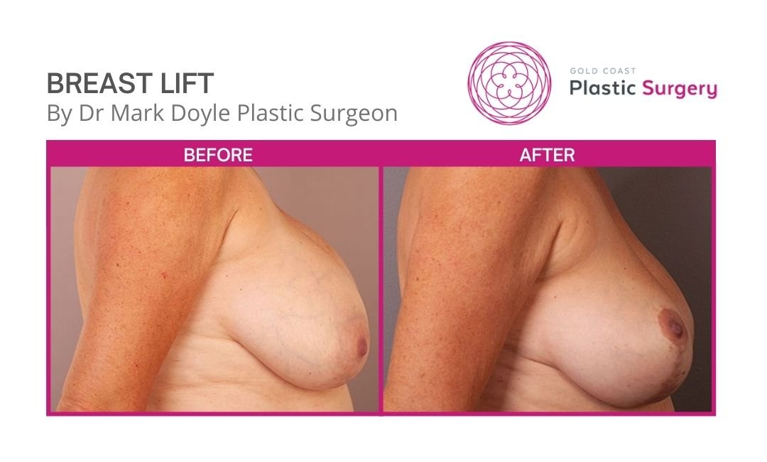 breast lift surgery nsw