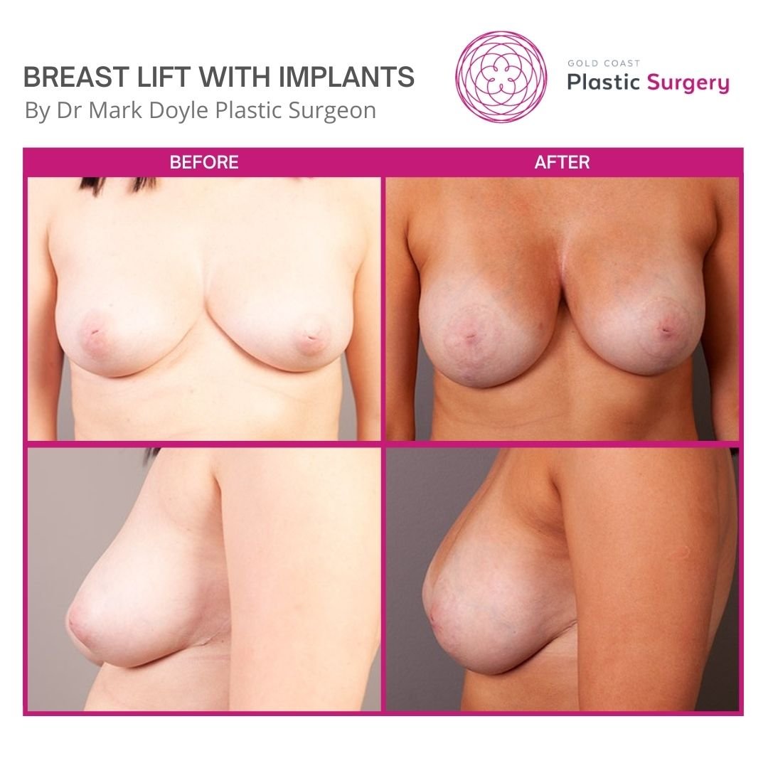 breast lift with implants brisbane images