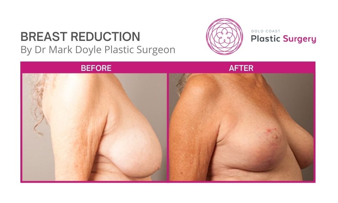 Breast Reduction Surgery  Dr Doyle Plastic Surgeon